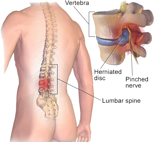 Lumbar Spondylosis_Transparent