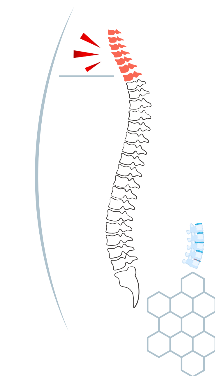 Cervical Spondylosis