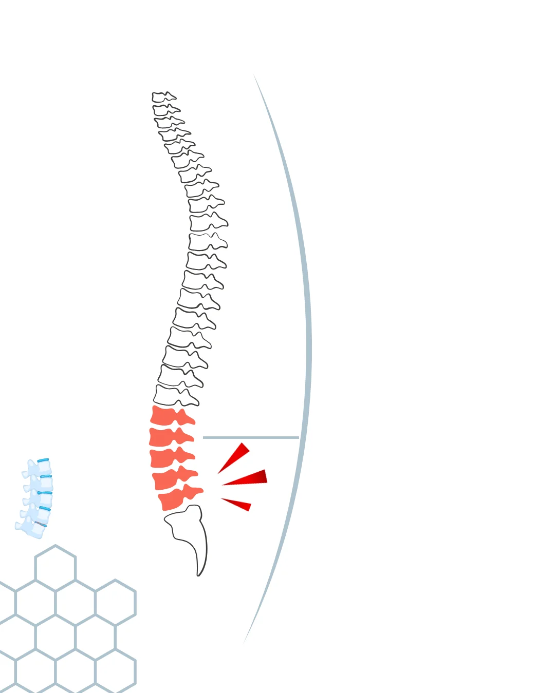 lumbar spondylosis