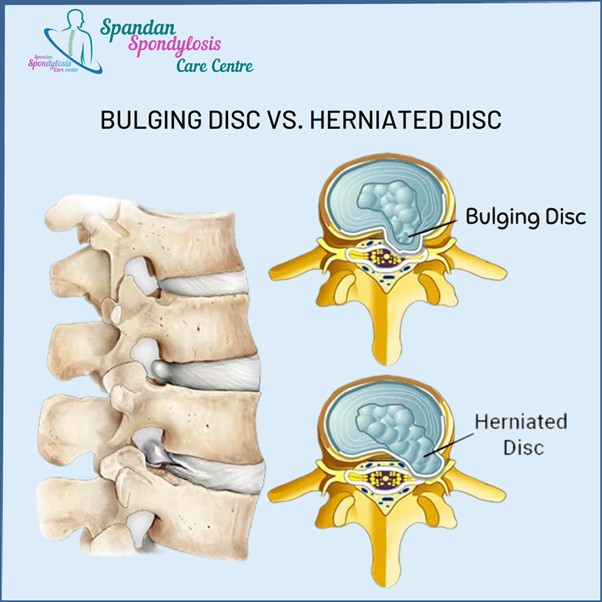 Herniated Disc and Bulging Disc